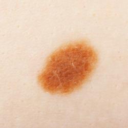 Example of moleRemoval